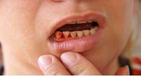Diabetes causes gum bleeding and you might lose teeth