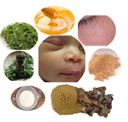 Natural treatment milia How to