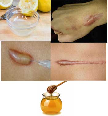 Home Remedies to Get Rid of Keloid scar
