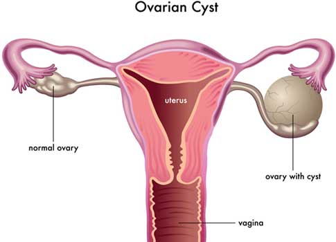 How is Ovarian Cyst Formed
