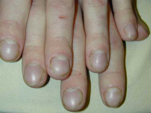 Clubbing of the Nails Indicates