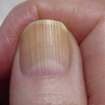 Vertical Ridges on Nails Indicate