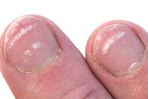 white Spots on the Nails Indicate
