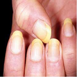 Yellow Nails Indicate
