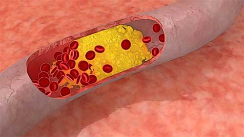 What is atherosclerosis