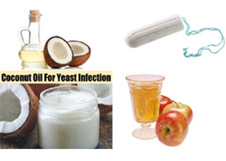  Vaginal Yeast Infection with Coconut Oil