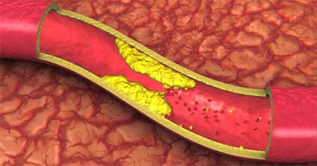 How atherosclerosis develops 