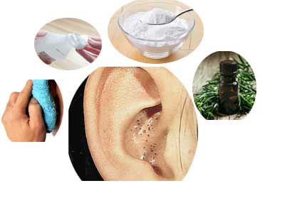How To Get Rid of Blackheads in Ears