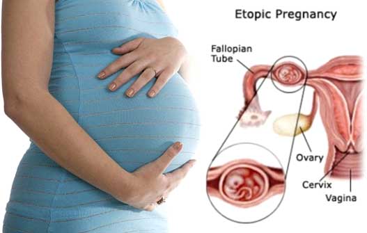 What is an Ectopic Pregnancy
