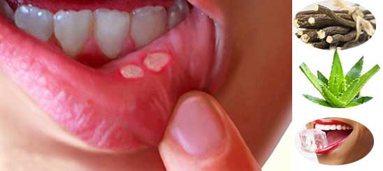 What is Mouth Ulcers:Cause,Symptoms, Home Remedies