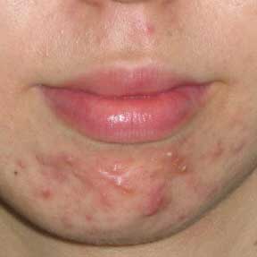 Home Remedies to Get Rid of Chin Acne