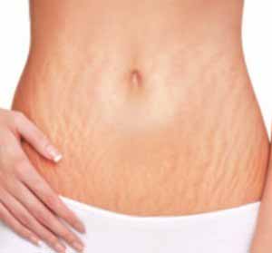 Remedies to Reduce Stretch Mark Naturally
