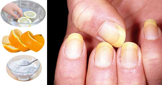 How to Get Rid of Yellow Nails