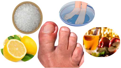 Ingrown Nails: Causes, Symptoms, Treatment and Home Remedies