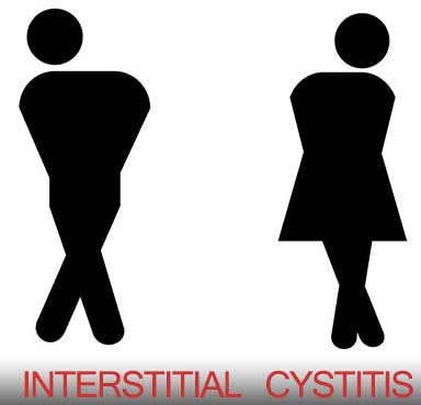  Symptoms of Interstitial Cystitis