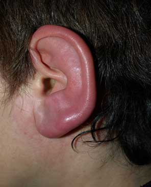 Red Hot Ear Pain: Symptoms, Causes, Manage and Home Remedies