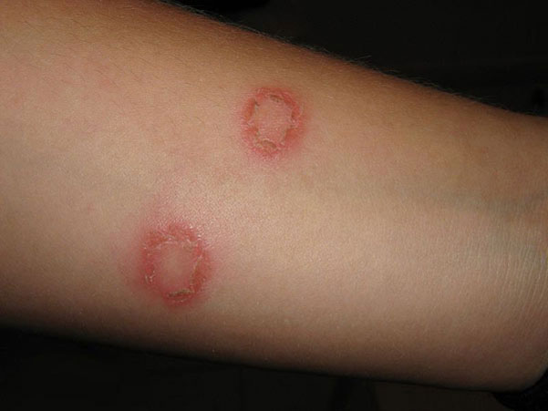 Home Remedies to Treat Ringworm Infection