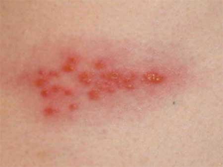 Shingles or Herpes Zoster