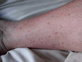 Symptoms of Chikungunya Fever
