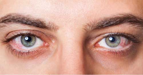  Symptoms of the Dry Eyes