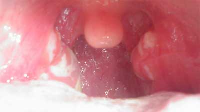 Symptoms of the Strep Throat