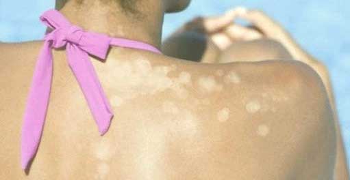  Tinea Versicolor or Fungal Skin Infection