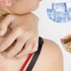 10 Home Remedies to Treat the Prickly Heat Rash