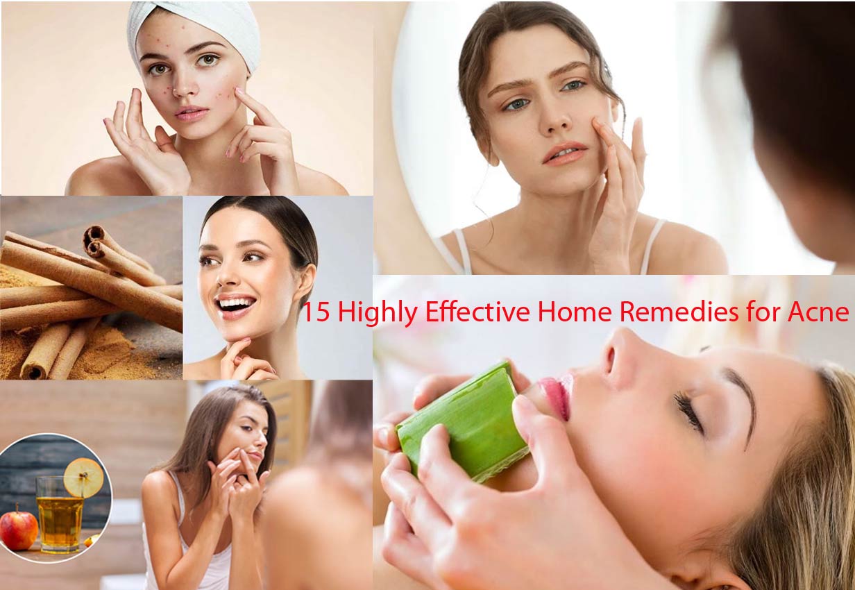 Highly Effective Home Remedies for Acne: Natural Solutions for Clearer Skin