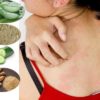 7 Natural Home Remedies to Treat Heat Bumps