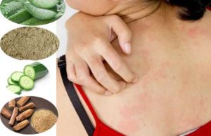 7 Natural Home Remedies to Treat Heat Bumps