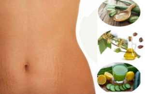 Natural Remedies To Get rid of Stretch Marks