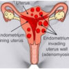 Home Remedies for Treating Symptoms of Adenomyosis