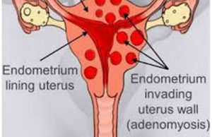 How to Treating Symptoms of Adenomyosis