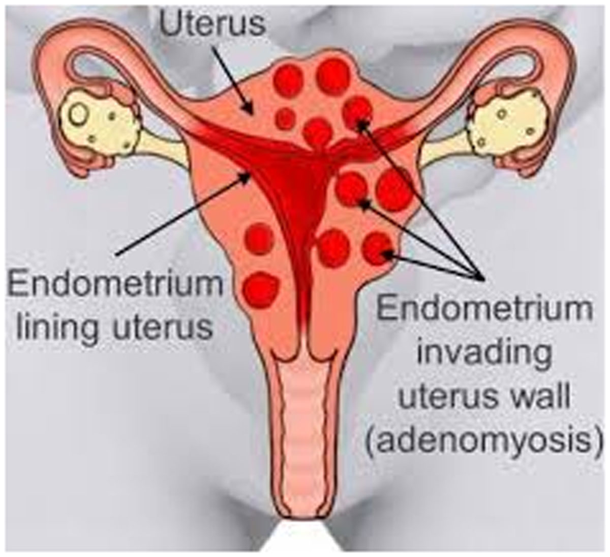 How to Treating Symptoms of Adenomyosis