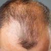 Alopecia: Types, Causes, Symptoms, Diagnosis and Management