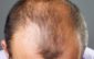 Alopecia