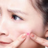 Natural and Best Medicine for Blind Pimples