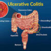 Ulcerative Colitis: Causes, Risk Factors, Types, Symptoms, Diagnosis, Treatment
