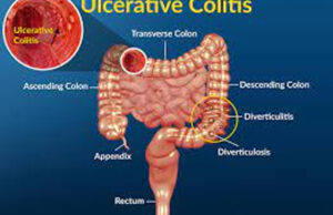 How to Reduce Ulcerative Colitis