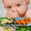 Chickenpox- Symptoms, complications, Treatment and Home Remedies