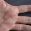 Dyshidrotic Eczema: Symptoms, Causes, Diagnosis, Natural Treatment