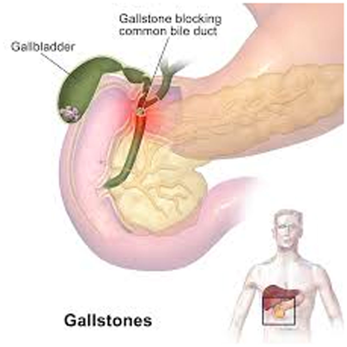 How to Reduce Gall Bladder Stones