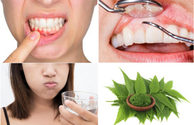 Home Remedies For Receding Gums