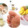Home Remedies for Corns on Feet that Works