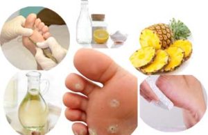 Home Remedies for Corns on Feet that Works