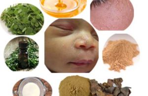 Home Remedies for Milia