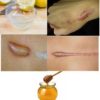 Home Remedies to Get rid of Keloids