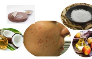 How to Get Rid of Pimple Marks Naturally