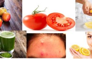 How to Get Rid of Acne on Forehead