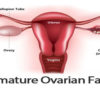 What Is Primary Ovarian Insufficiency or Primary Ovarian Failure :Causes ,Symptoms and Complications , Diagnosed